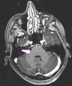 Диагностика и лечение невриномы за рубежом