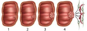 стадии опухолей кишечника