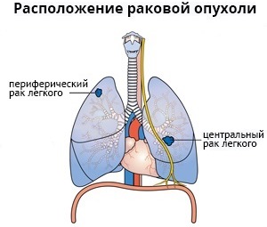 центральный вид рака легкого