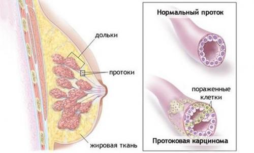 Протоковый рак молочной железы