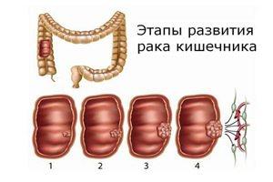 стадии рака кишечника