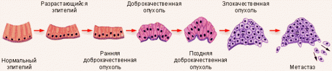 образование раковой опухоли