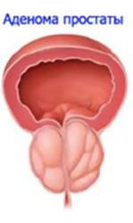 аденома простаты