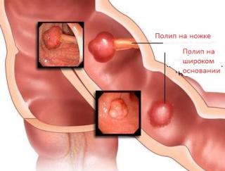 Полипы кишечника