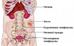 метастазы при раке простаты