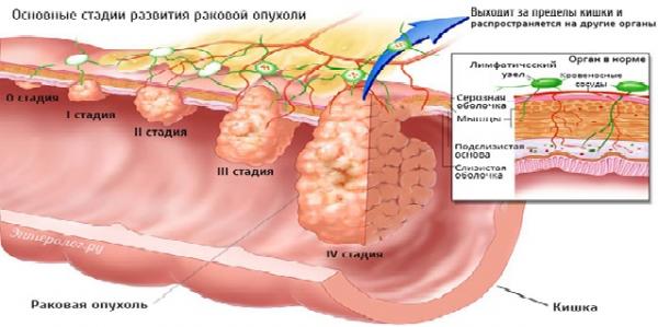 Рак кишечника прогноз жизни. Новообразование в кишечнике.