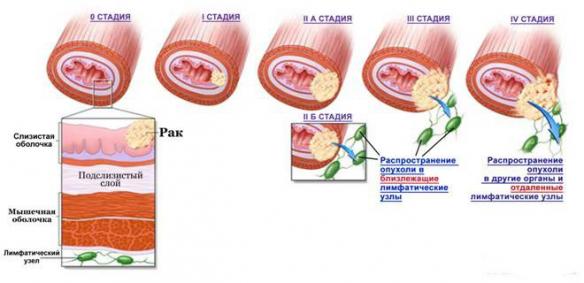 рак пищевода стадии