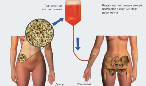 пересадка костного мозга